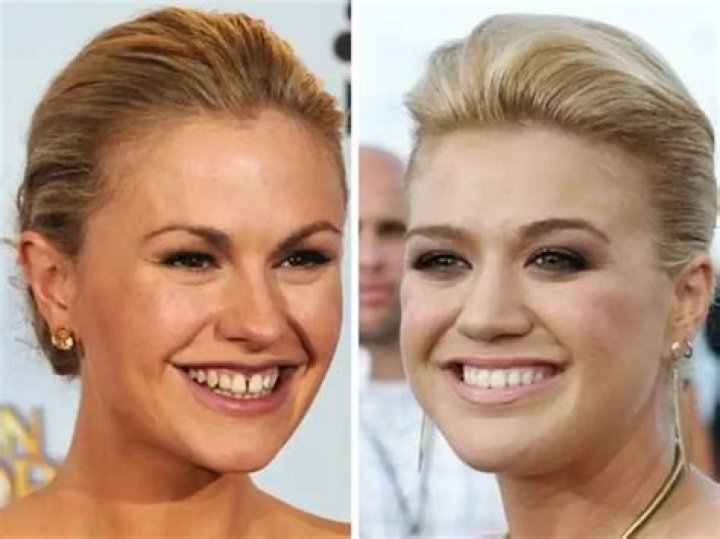 Celebrities with Overbites: A Closer Look at Their Unique Smiles
